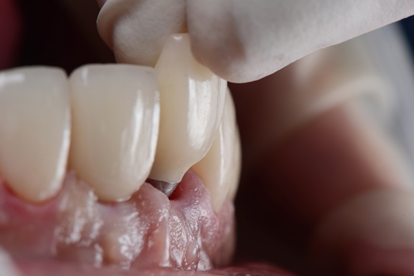 Can A General Dentist Repair A Dental Implant Restoration?