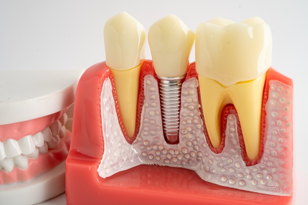 Teeth Replacement    : Dental Implants