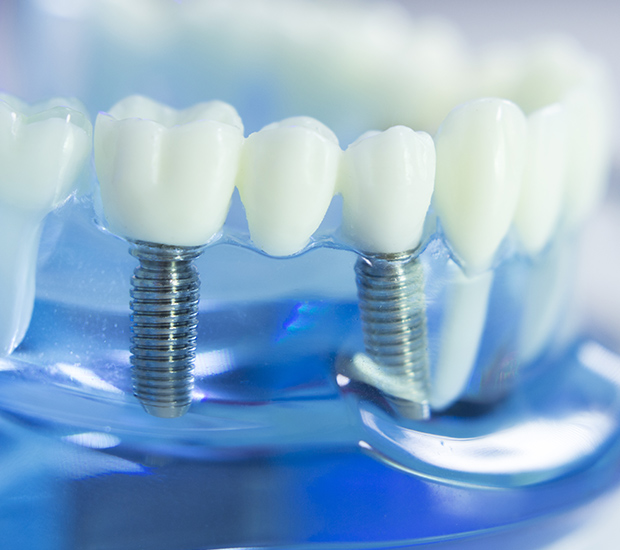 Saginaw Dental Implants